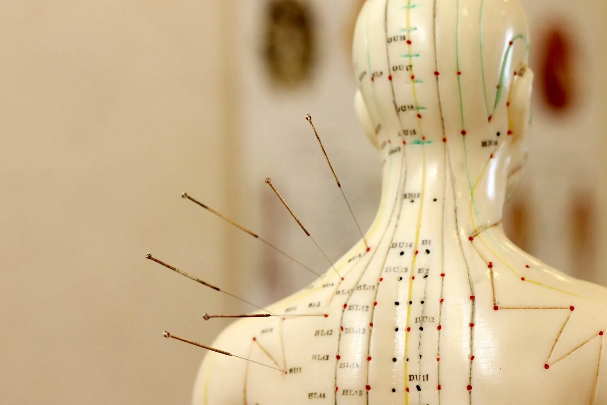 Acupuncture needle being inserted into scalp acupuncture point at Joyful TCM Clinic